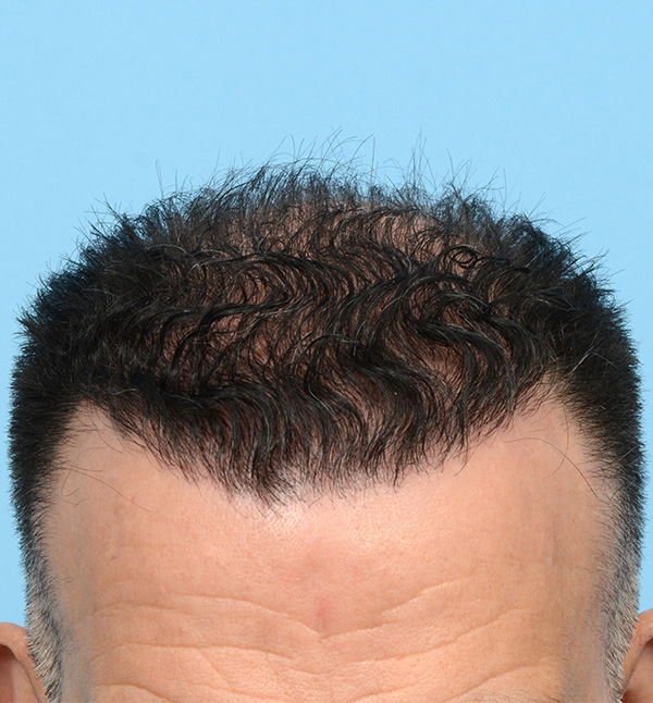 Fue Before and After | Dr. Jeffrey Wise