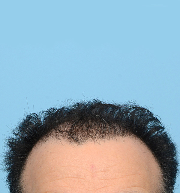 Fue Before and After | Dr. Jeffrey Wise