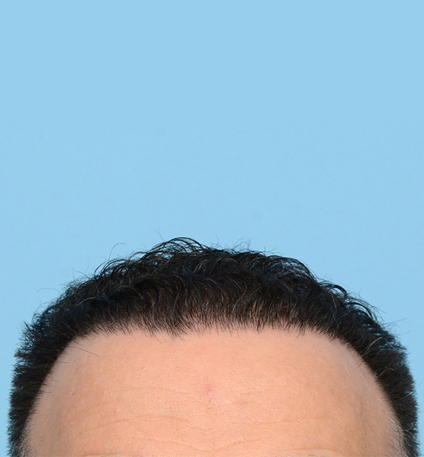 Fue Before and After | Dr. Jeffrey Wise