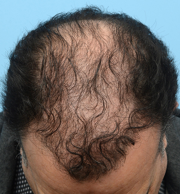 Fue Before and After | Dr. Jeffrey Wise