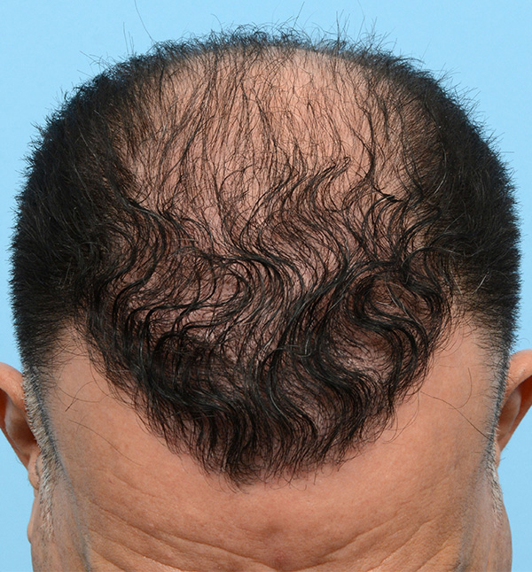 Fue Before and After | Dr. Jeffrey Wise