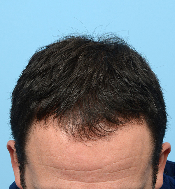 Fue Before and After | Dr. Jeffrey Wise