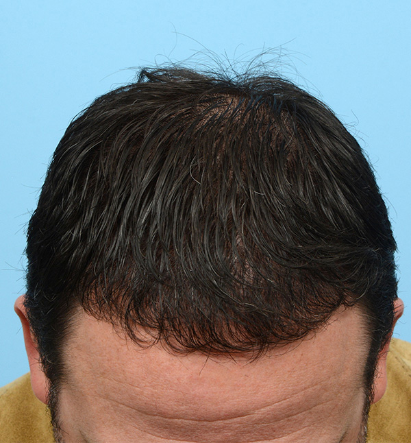 Fue Before and After | Dr. Jeffrey Wise