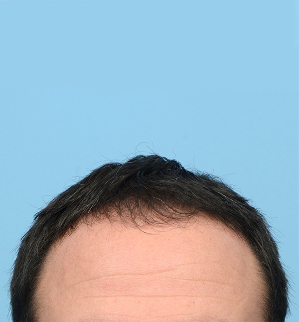 Fue Before and After | Dr. Jeffrey Wise