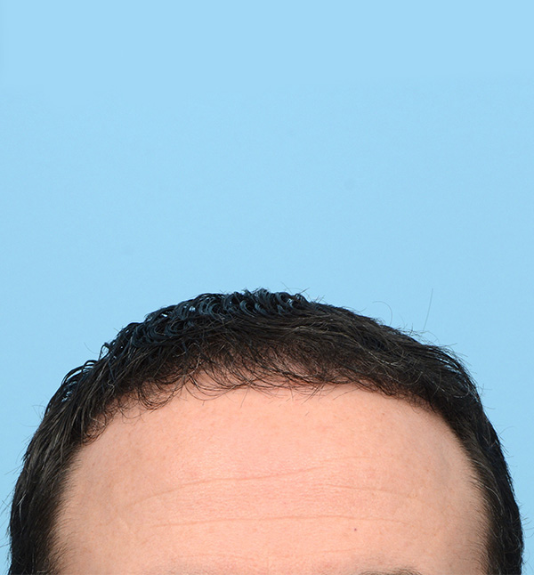 Fue Before and After | Dr. Jeffrey Wise