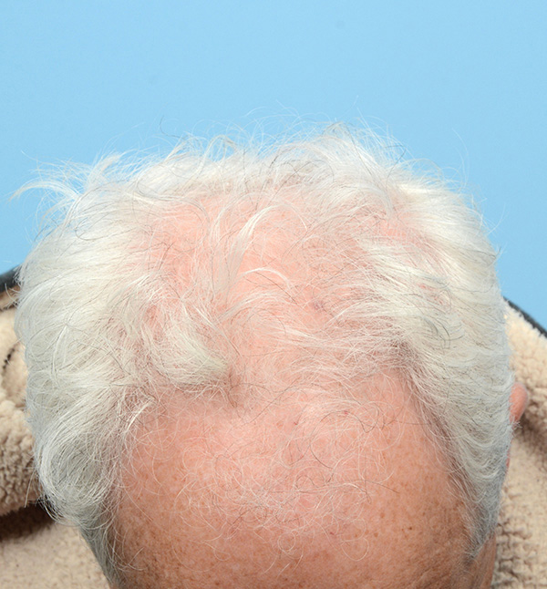 Fue Before and After | Dr. Jeffrey Wise