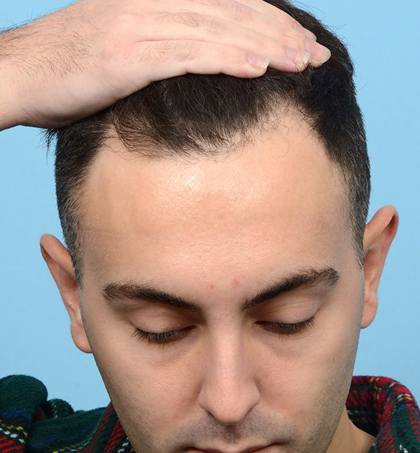 Fue Before and After | Dr. Jeffrey Wise