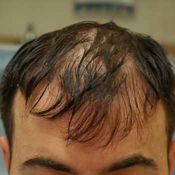 Fue Before and After | Dr. Jeffrey Wise