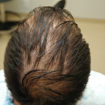 Fue Before and After | Dr. Jeffrey Wise