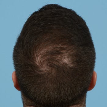 Fue Before and After | Dr. Jeffrey Wise