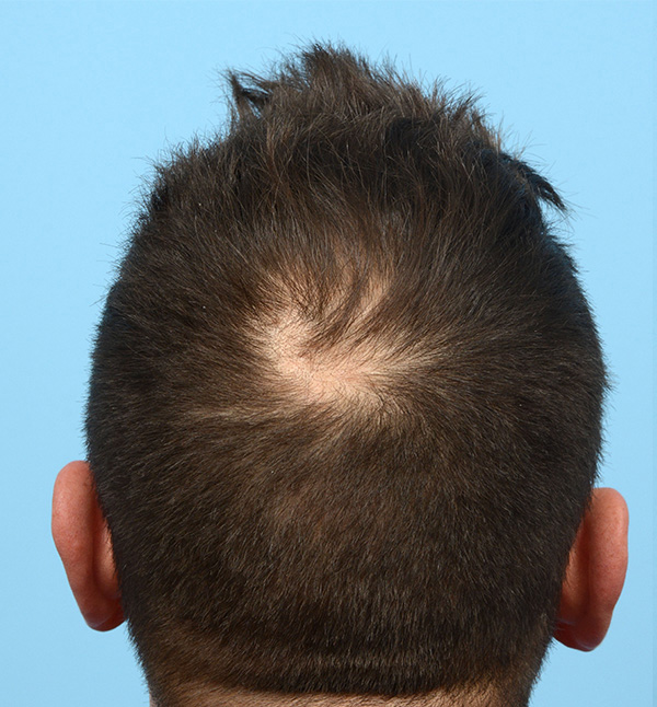 Fue Before and After | Dr. Jeffrey Wise