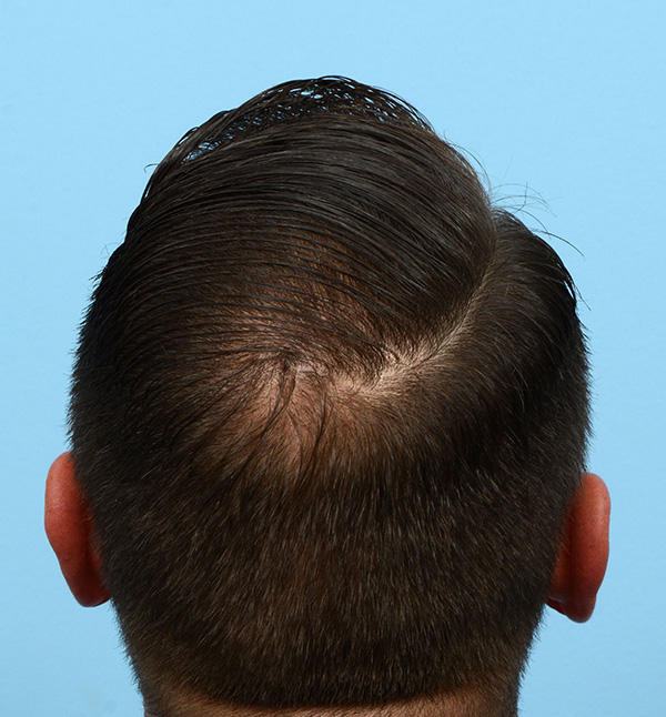 Fue Before and After | Dr. Jeffrey Wise