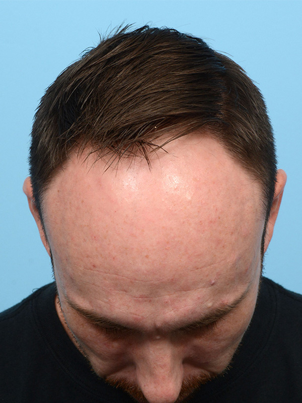 Fue Before and After | Dr. Jeffrey Wise