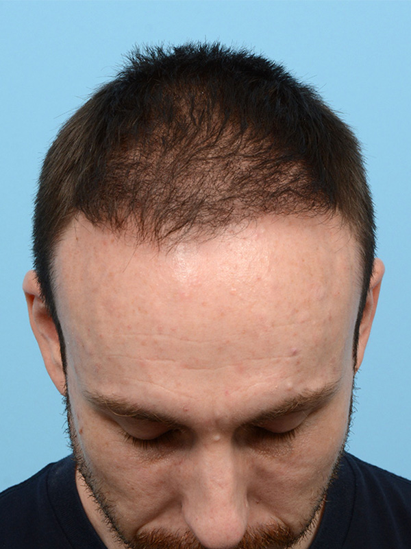 Fue Before and After | Dr. Jeffrey Wise