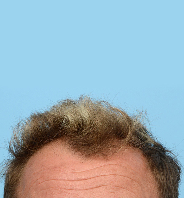 Fue Before and After | Dr. Jeffrey Wise