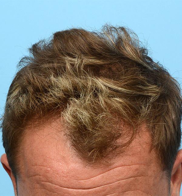 Fue Before and After | Dr. Jeffrey Wise