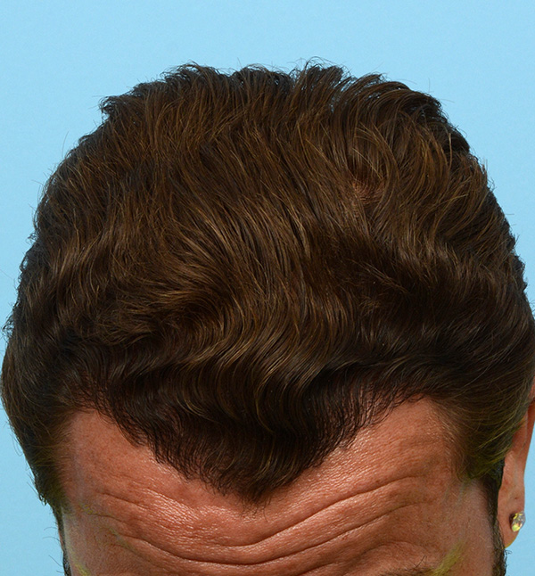 Fue Before and After | Dr. Jeffrey Wise