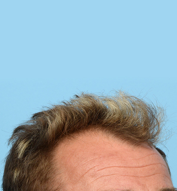 Fue Before and After | Dr. Jeffrey Wise