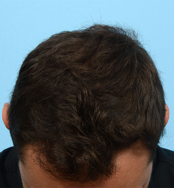 Fue Before and After | Dr. Jeffrey Wise