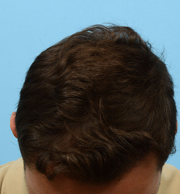 Fue Before and After | Dr. Jeffrey Wise