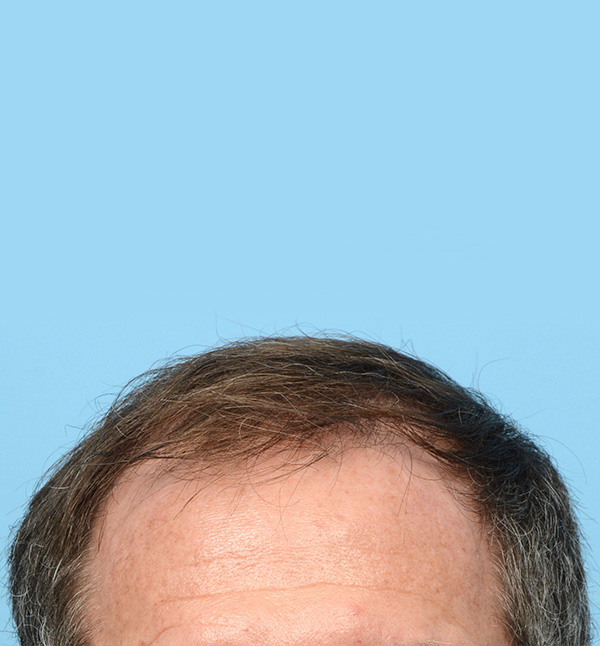 Fue Before and After | Dr. Jeffrey Wise