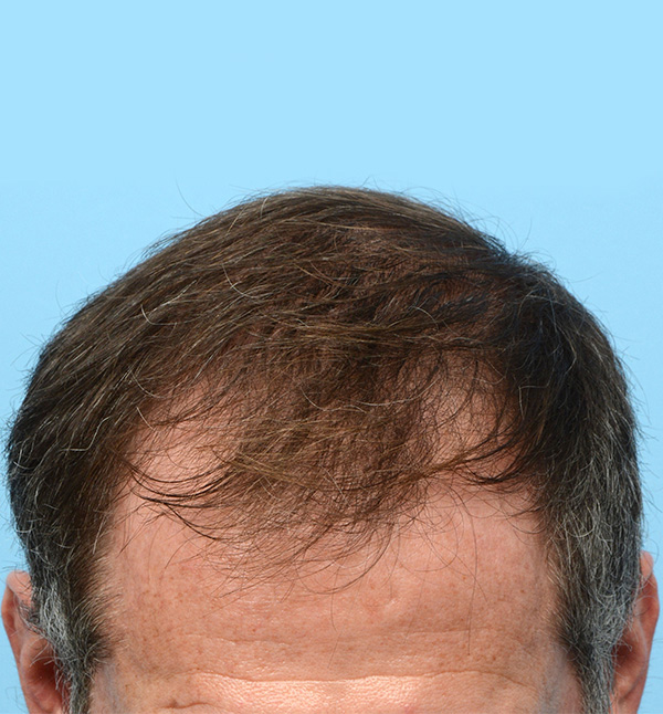 Fue Before and After | Dr. Jeffrey Wise