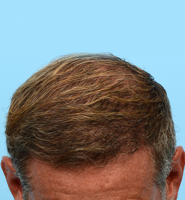 Fue Before and After | Dr. Jeffrey Wise