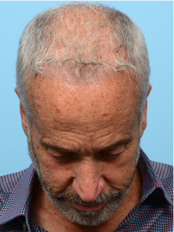 Fue Before and After | Dr. Jeffrey Wise