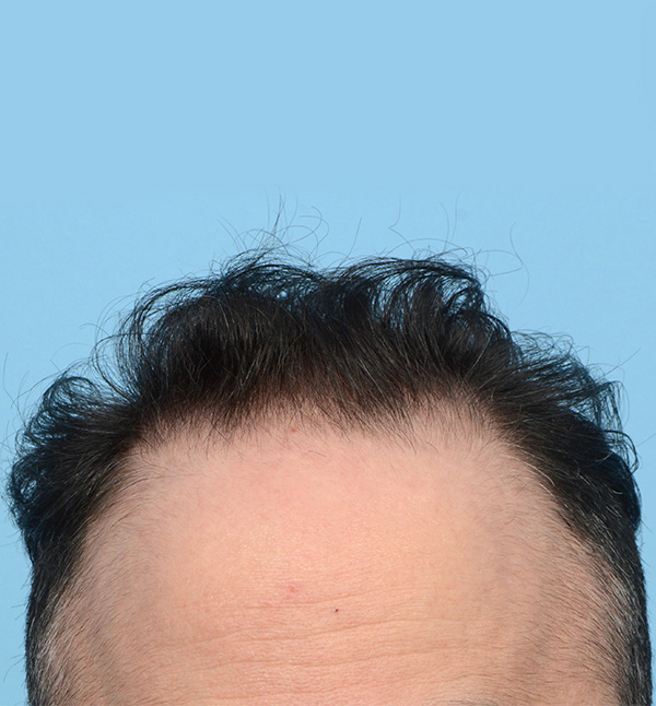 Fue Before and After | Dr. Jeffrey Wise