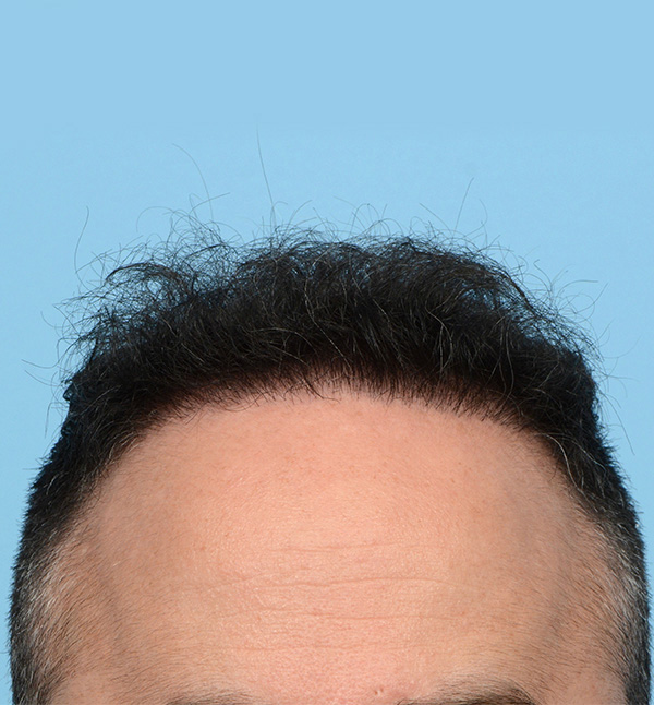 Fue Before and After | Dr. Jeffrey Wise