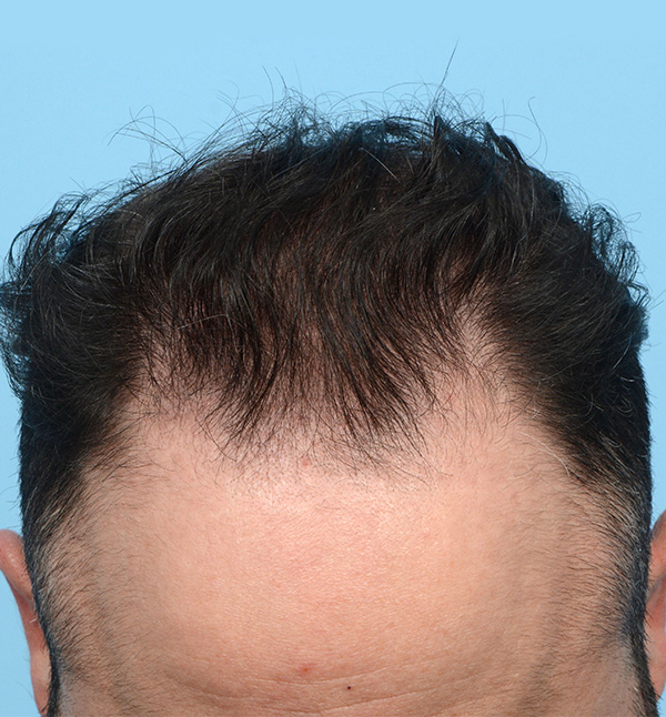 Fue Before and After | Dr. Jeffrey Wise