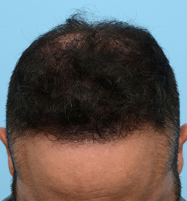 Fue Before and After | Dr. Jeffrey Wise