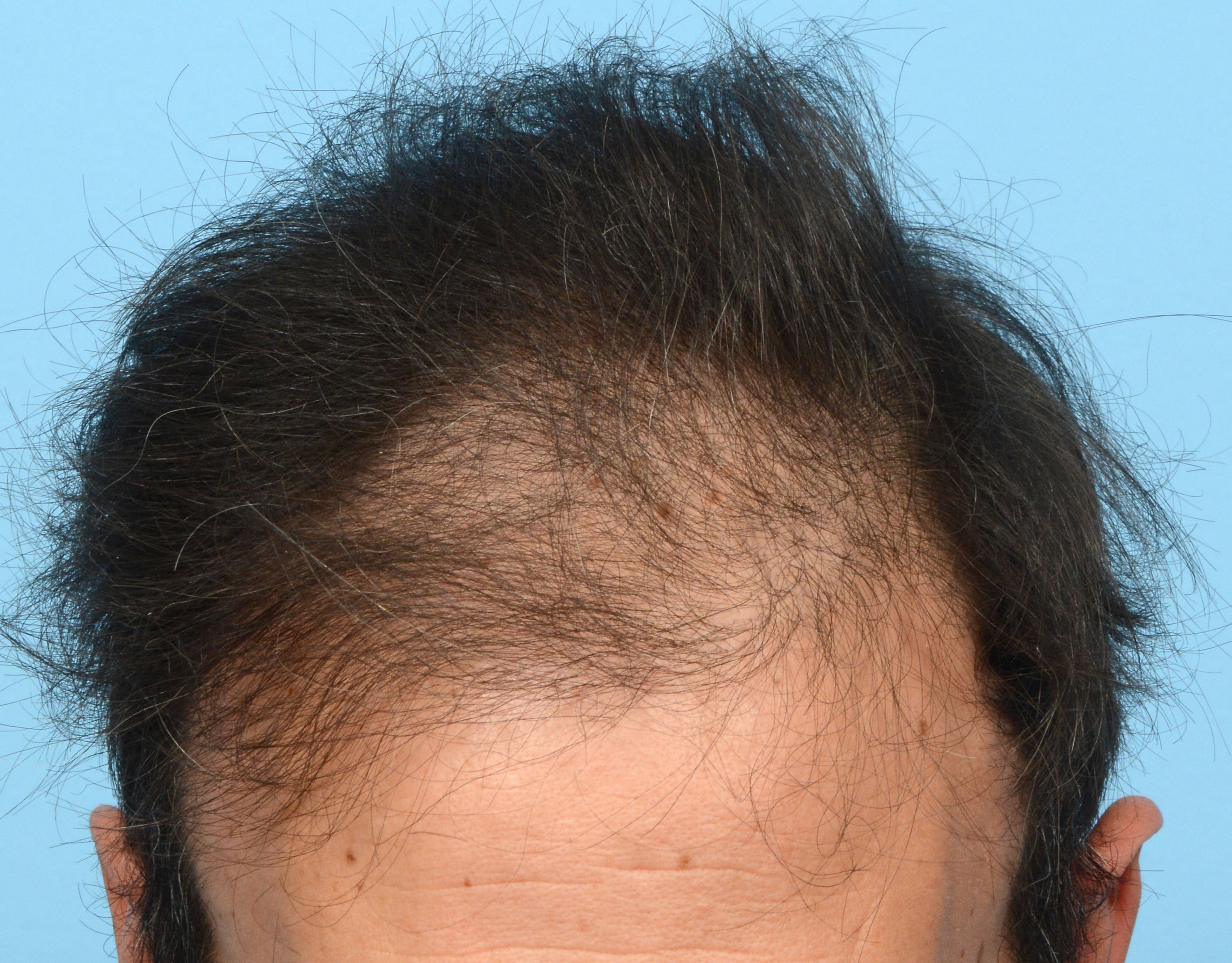 Fue Before and After | Dr. Jeffrey Wise