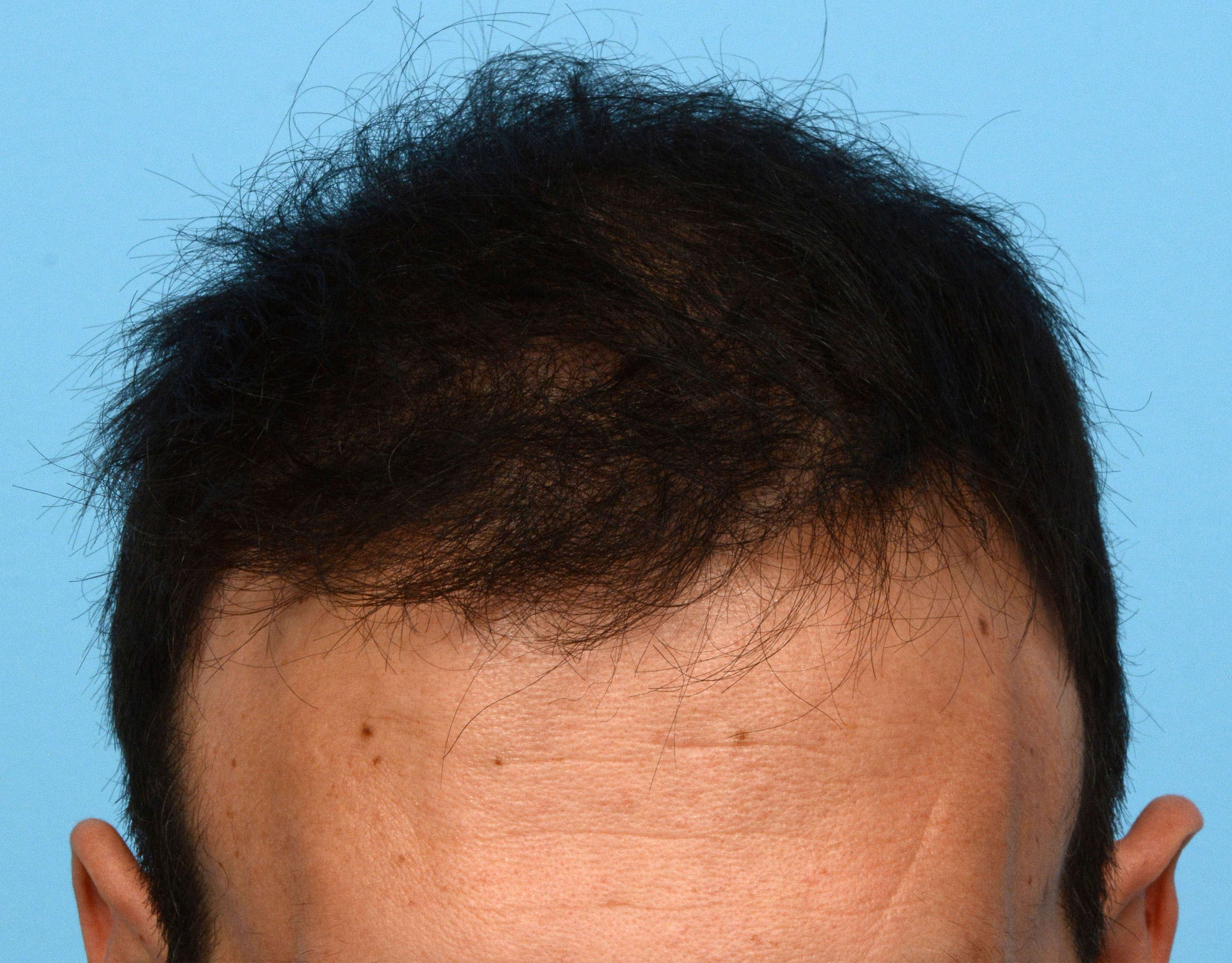 Fue Before and After | Dr. Jeffrey Wise