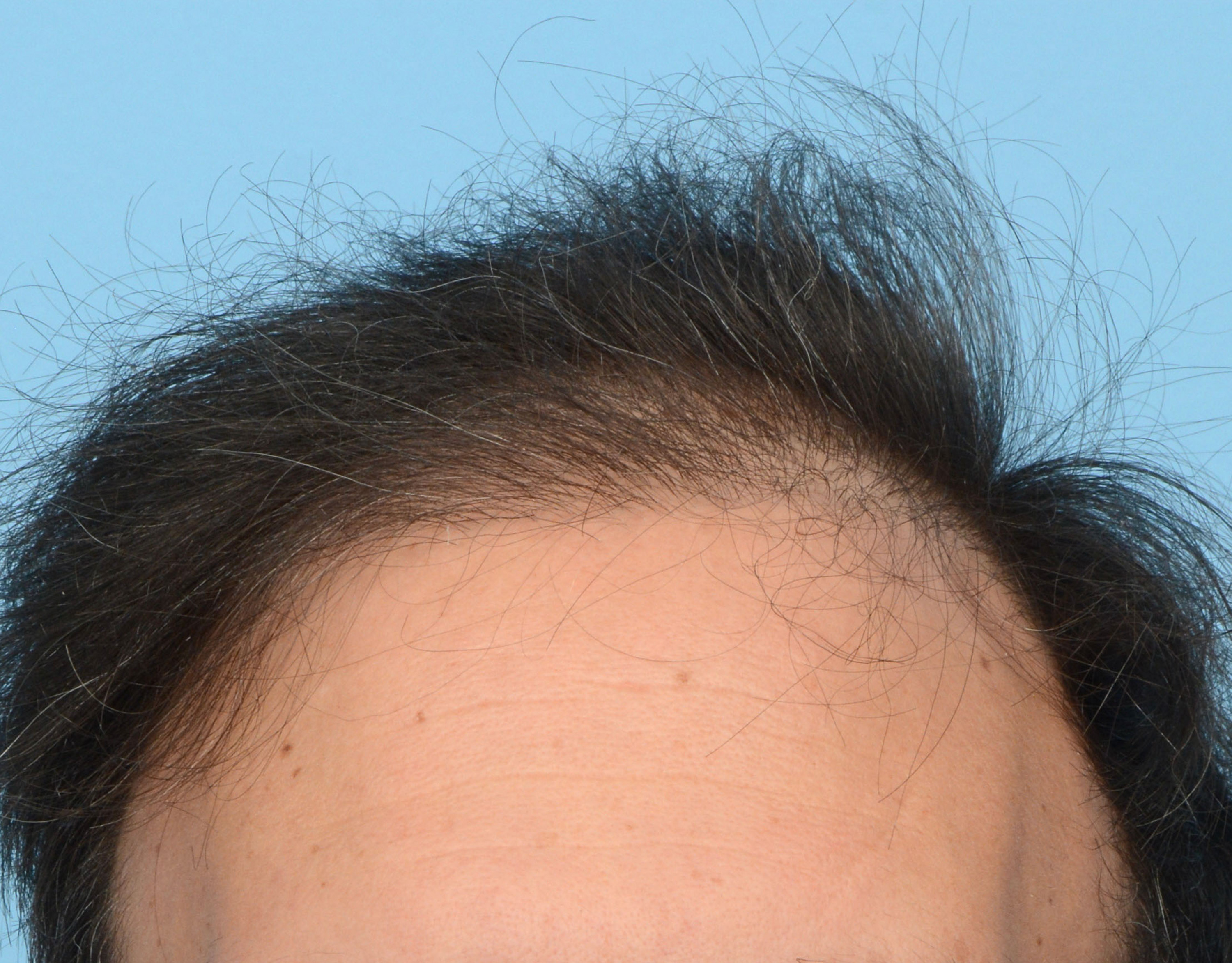 Fue Before and After | Dr. Jeffrey Wise