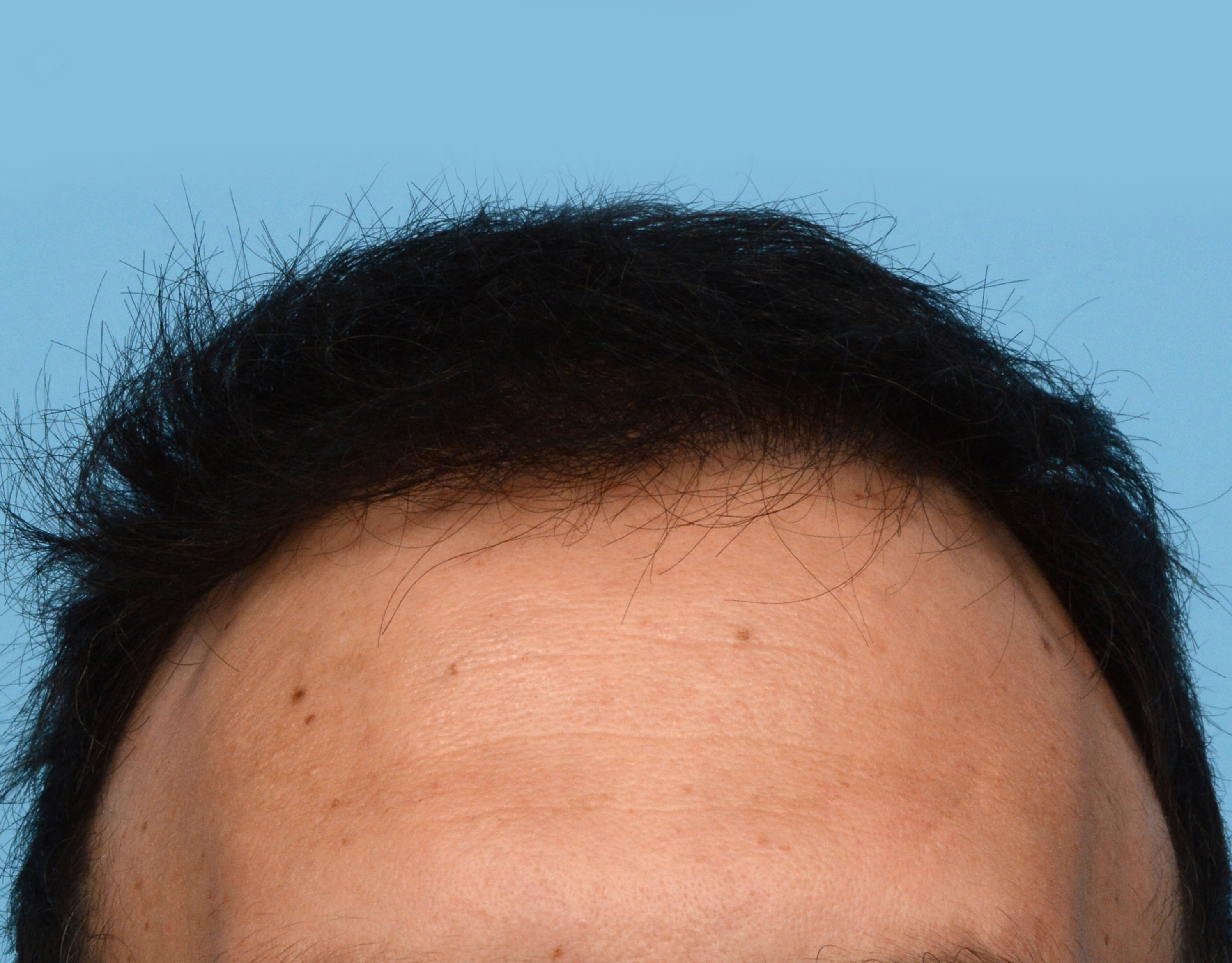 Fue Before and After | Dr. Jeffrey Wise