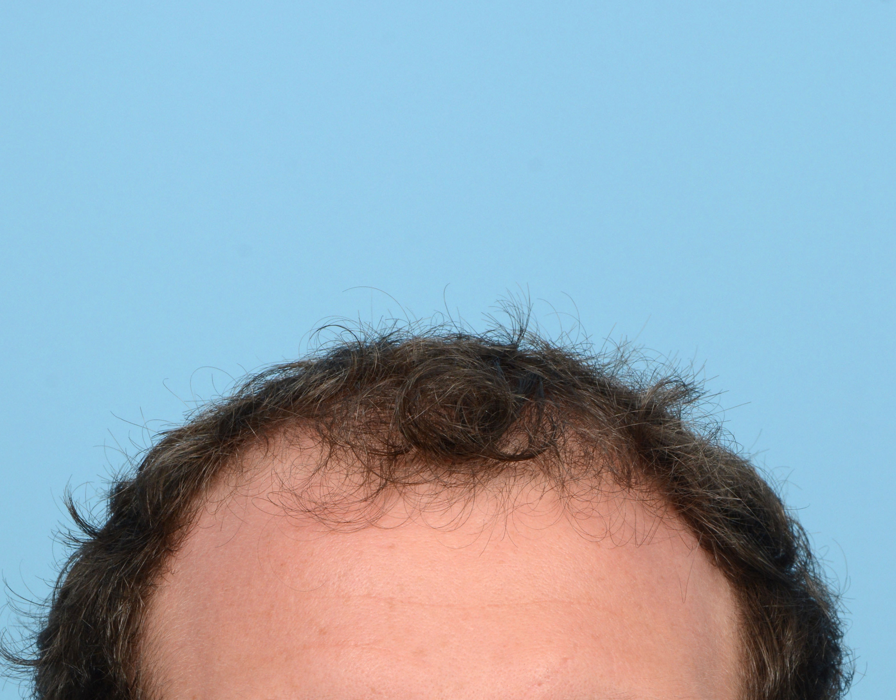 Fue Before and After | Dr. Jeffrey Wise