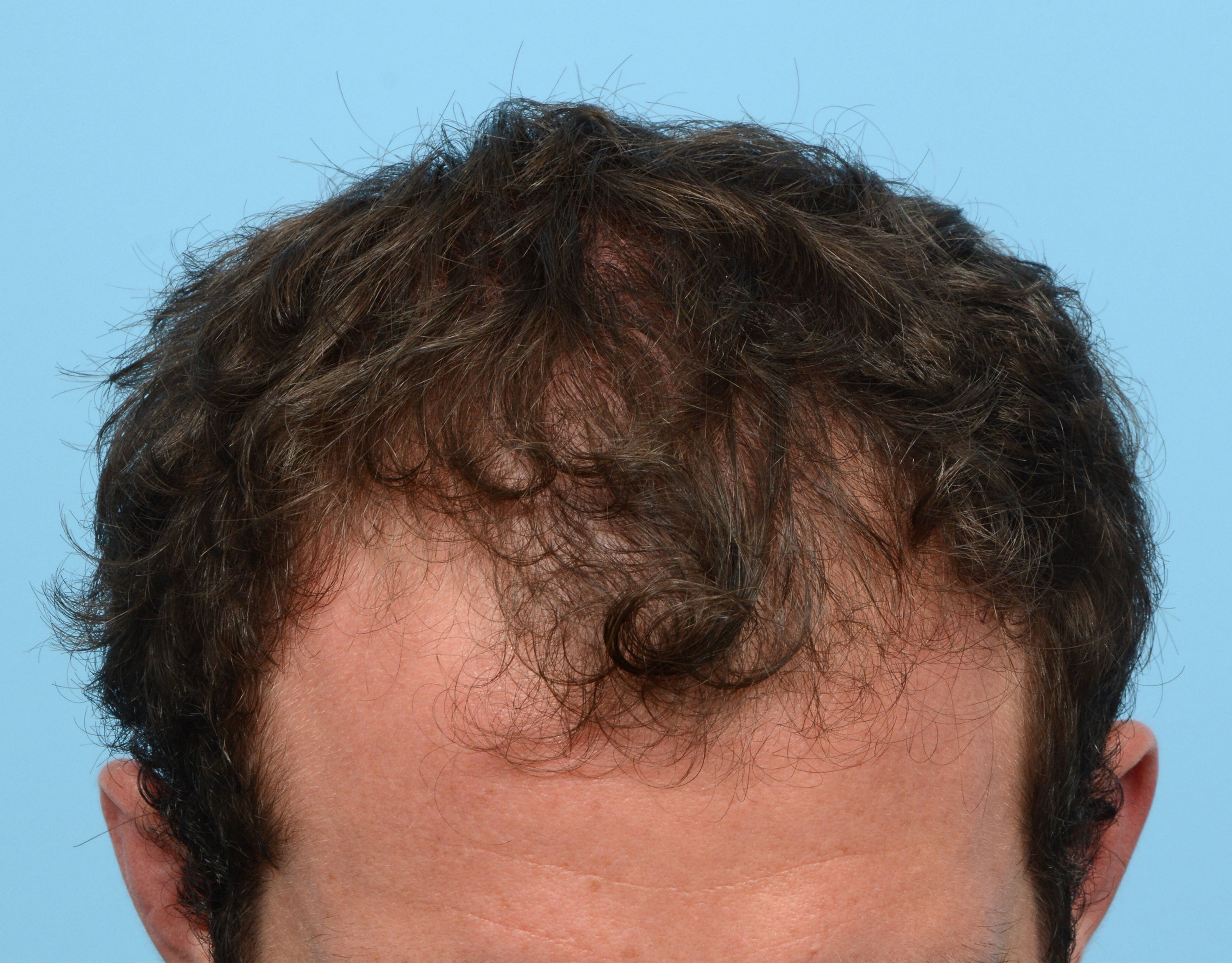 Fue Before and After | Dr. Jeffrey Wise