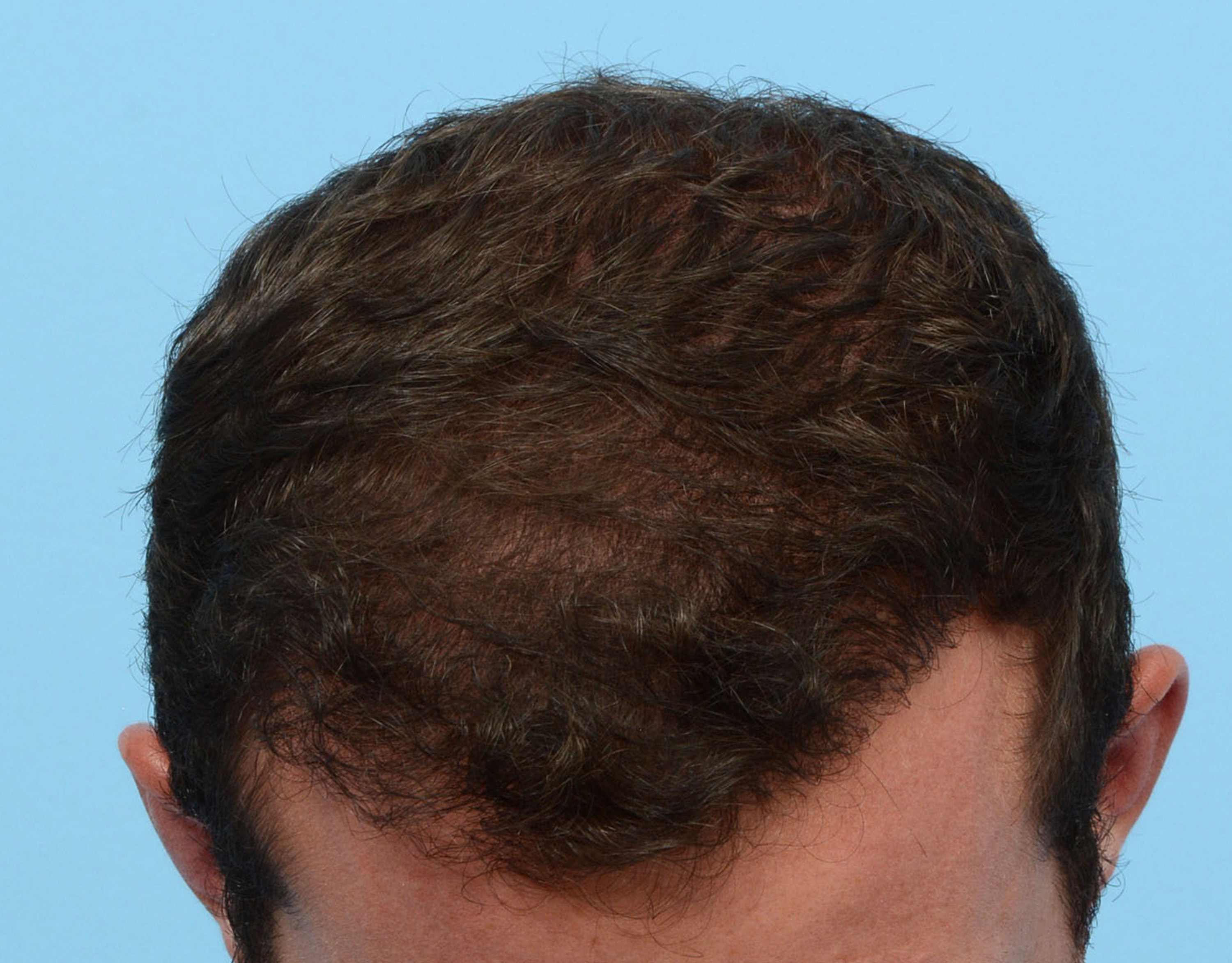 Fue Before and After | Dr. Jeffrey Wise