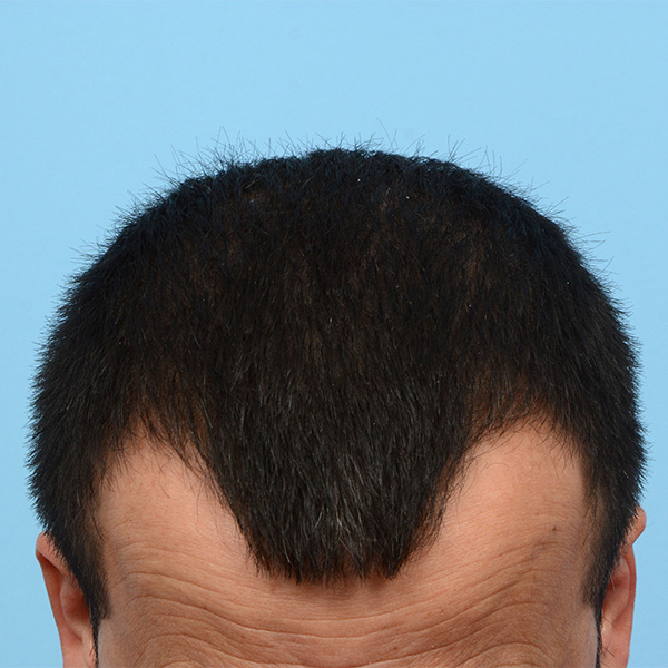 Fue Before and After | Dr. Jeffrey Wise