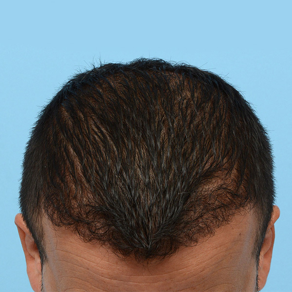 Fue Before and After | Dr. Jeffrey Wise