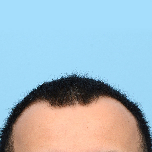 Fue Before and After | Dr. Jeffrey Wise