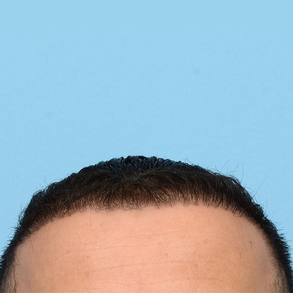 Fue Before and After | Dr. Jeffrey Wise