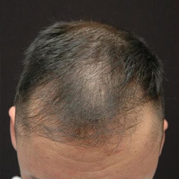 Fue Before and After | Dr. Jeffrey Wise