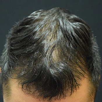 Fue Before and After | Dr. Jeffrey Wise