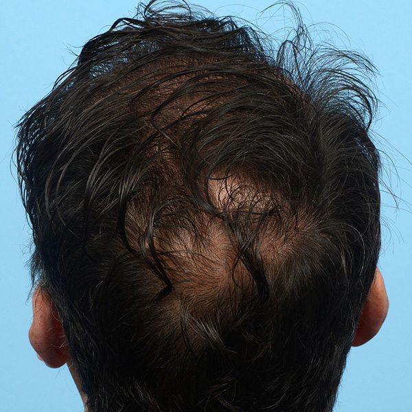 Fue Before and After | Dr. Jeffrey Wise