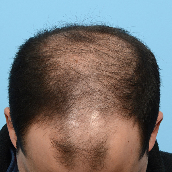 Fue Before and After | Dr. Jeffrey Wise