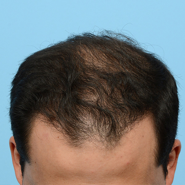 Fue Before and After | Dr. Jeffrey Wise