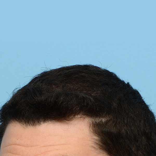 Fue Before and After | Dr. Jeffrey Wise