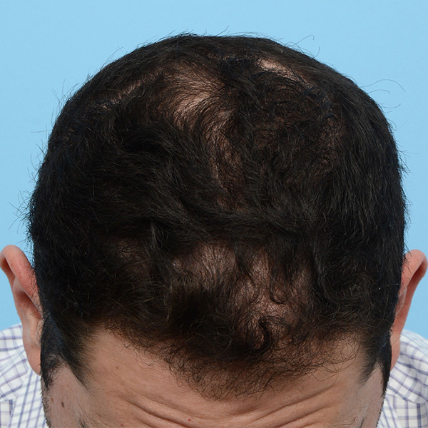 Fue Before and After | Dr. Jeffrey Wise